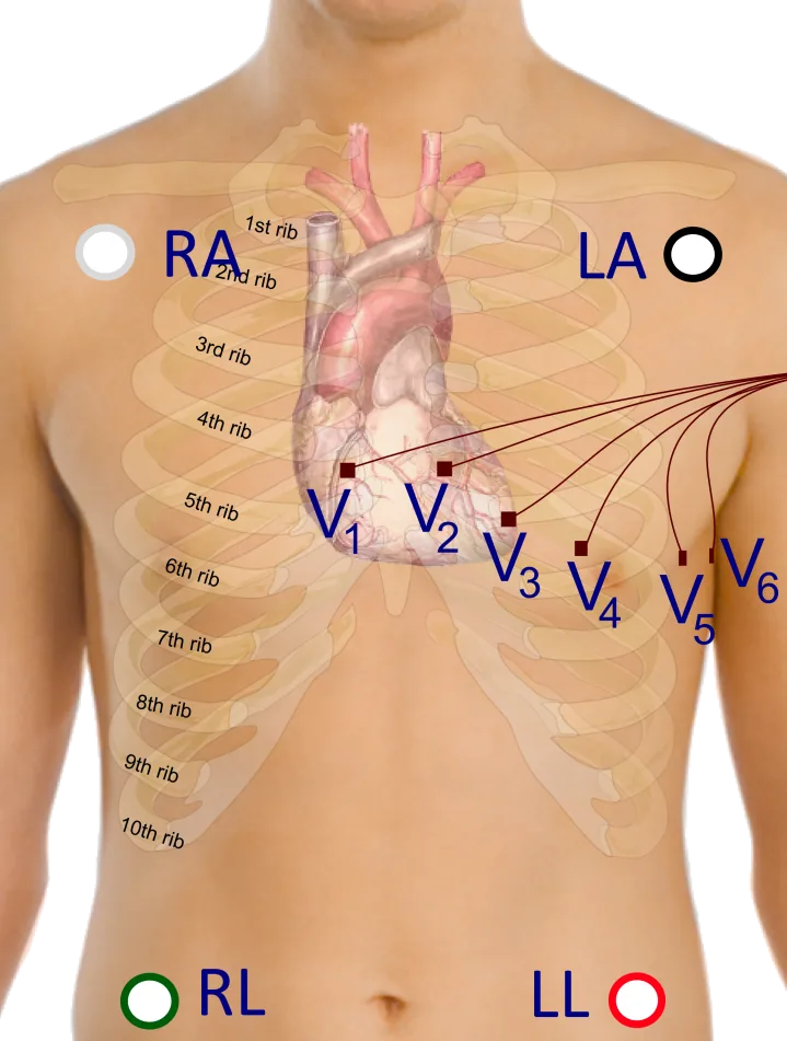 Traditional_ECG_Electrode_Placement.png